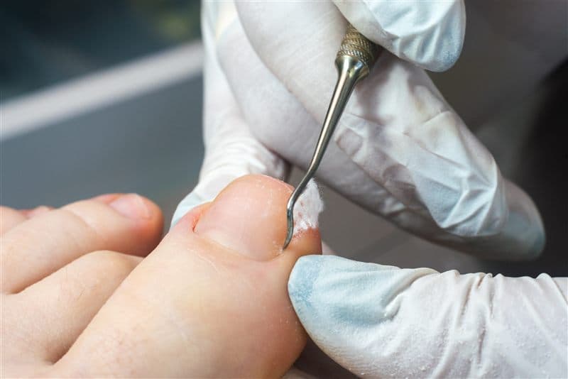 Cirugía para uñas encarnadas en Arzúa